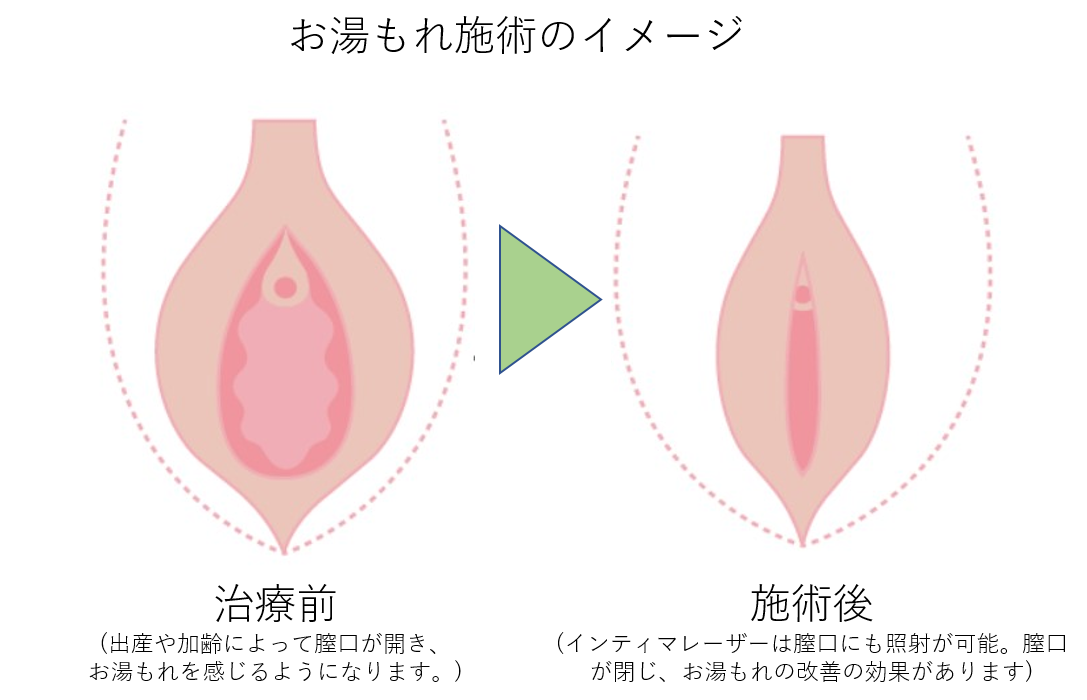 お湯漏れ施術のイメージ